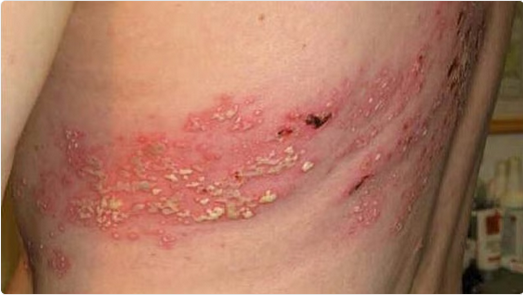 الخضيري يحذّر: مناعة الحزام الناري قد لا تستمر أكثر من عامين 1 888 2 10